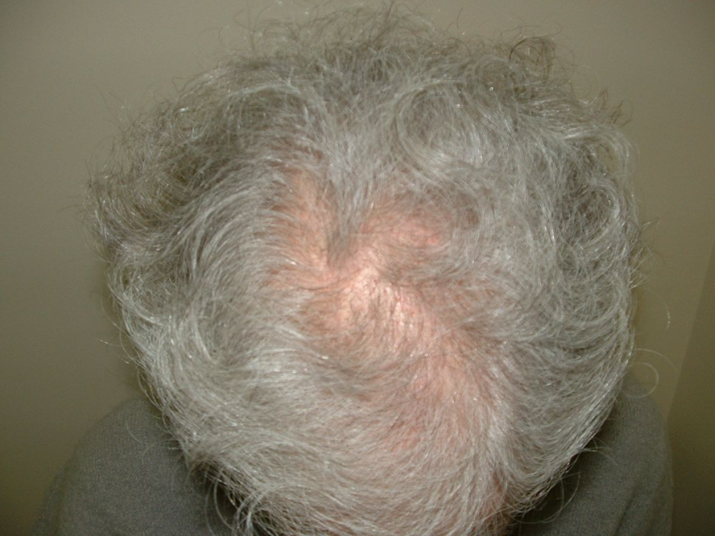 Thinning Hair