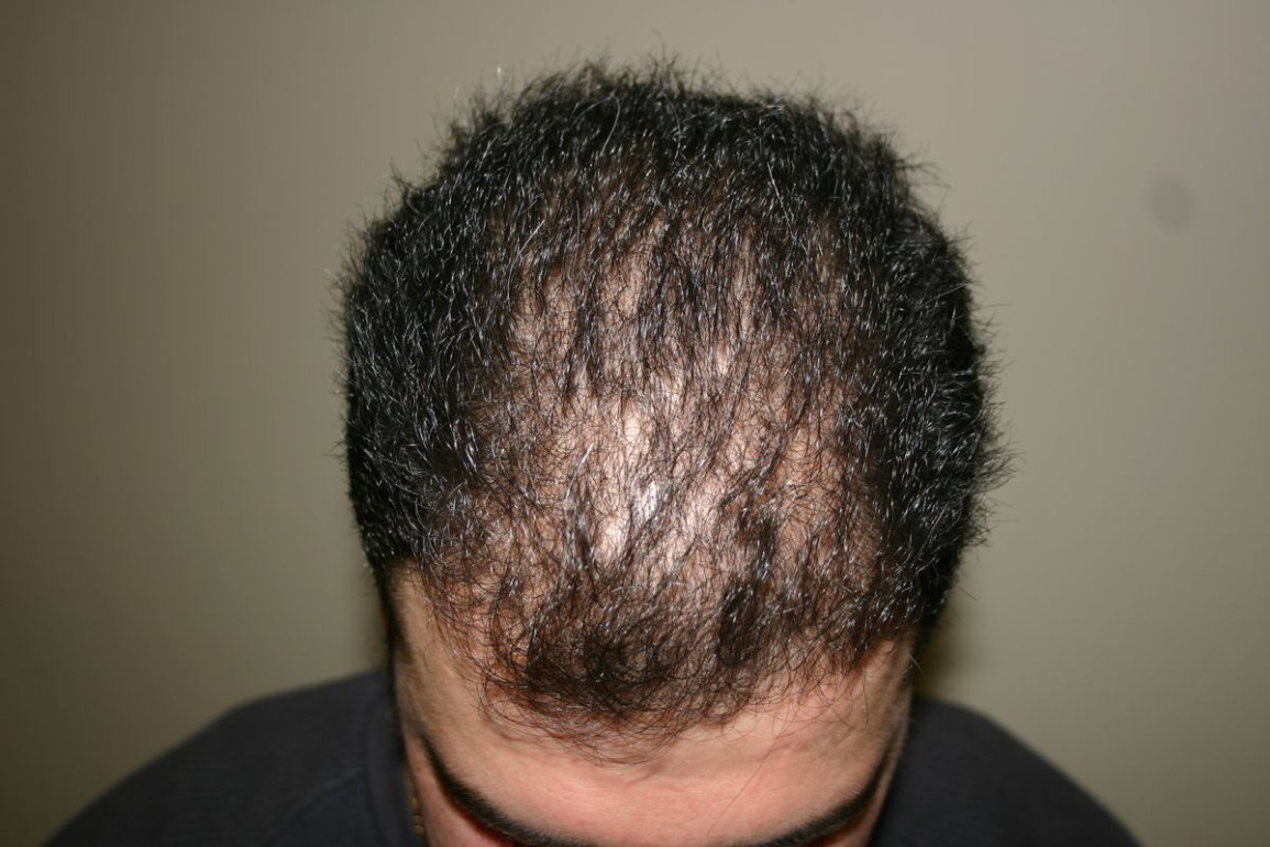 Hairline Recession